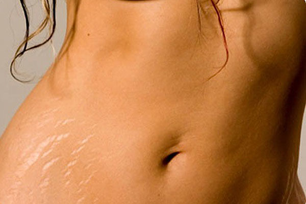 Как убрать растяжки на животе?